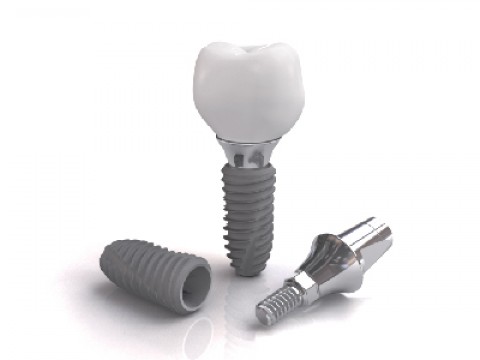 LỢI ÍCH KHI CẤY GHÉP IMPLANT NHA KHOA CÙNG DENTIUM